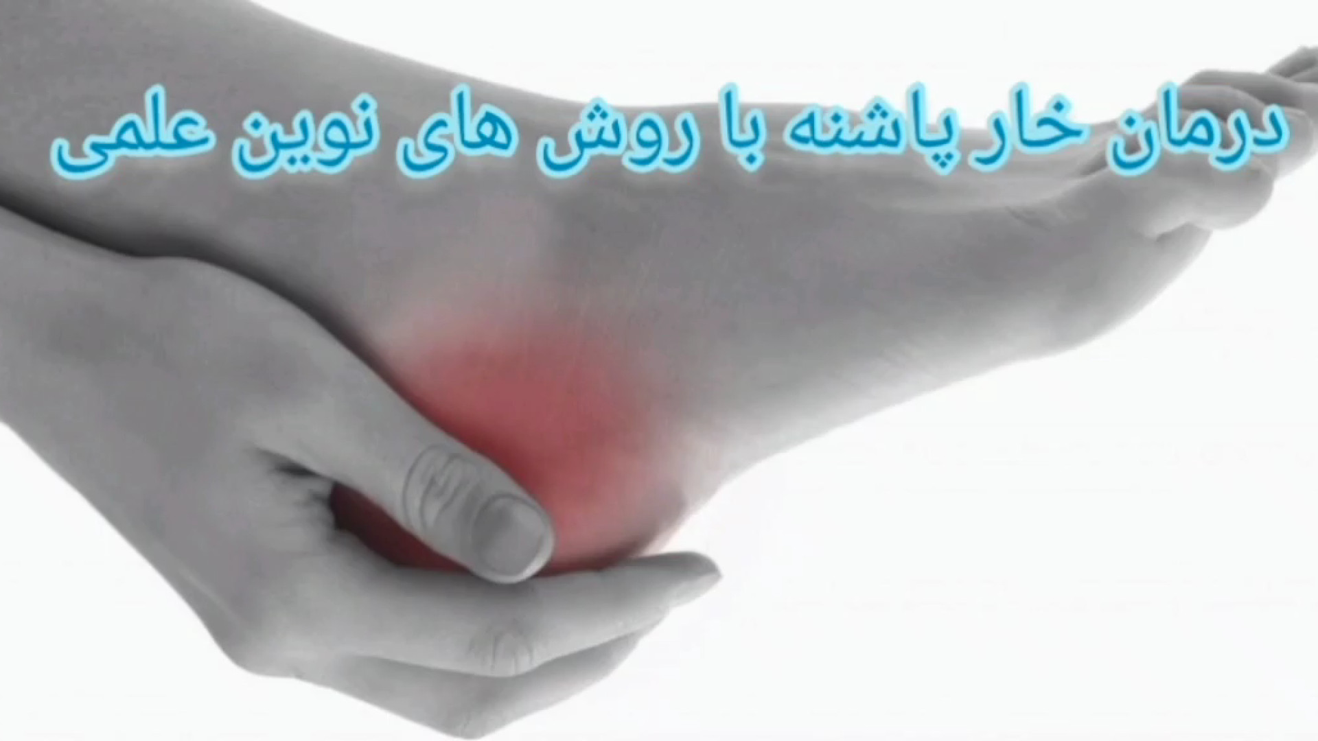 درمان خار پاشنه (چطور خار پاشنه پا را درمان کنیم روش علمی) TAVI