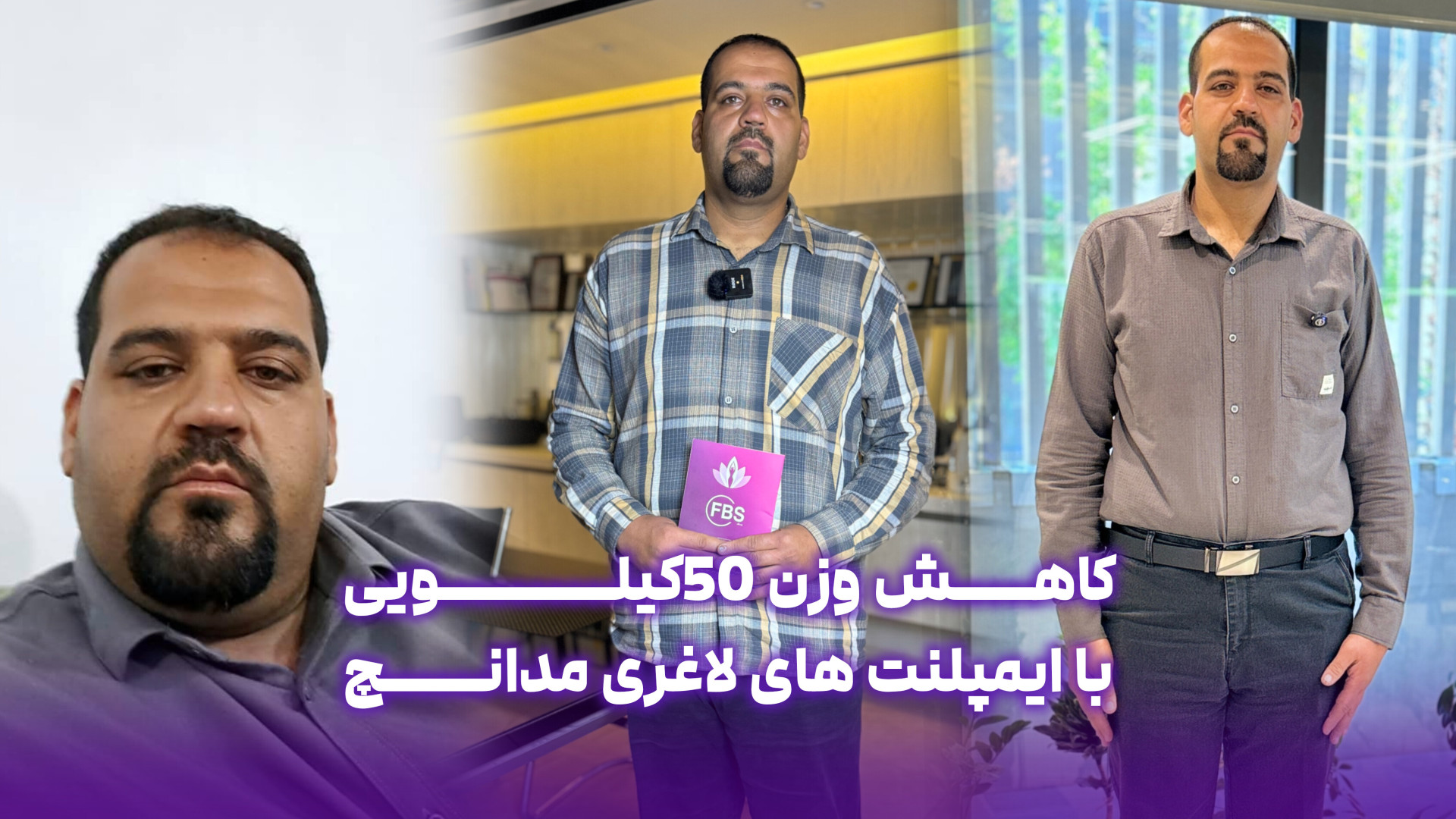 کاهش وزن ۵۰ کیلویی با ایمپلنت های لاغری مدانچ رفع غبغب