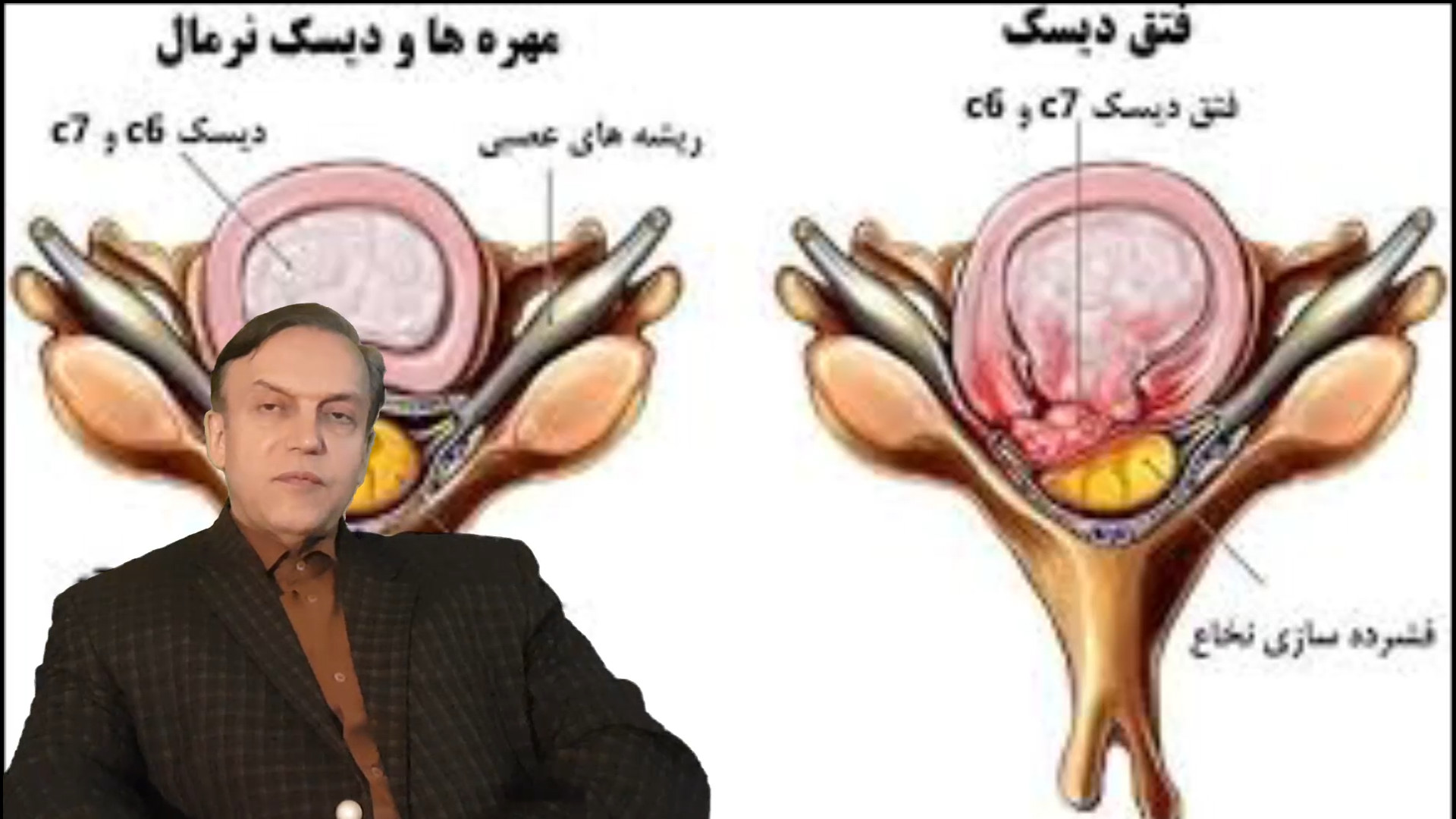 پرسش و پاسخ با استاد محمدرضا صفاری: علائم نشاندهنده بیماری فتق دیسک بین مهره ای رفع چین و چروک