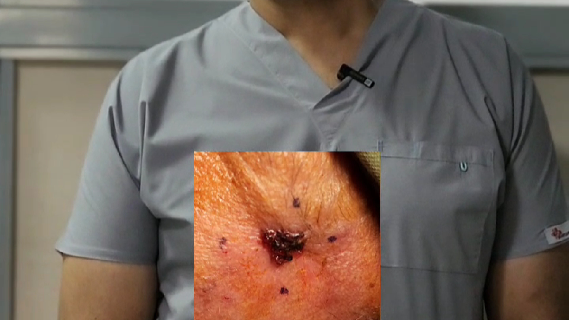 تومور پوستی ملانوم ( melanoma) ؛ دکتر حسین گندمکار اما واتسون