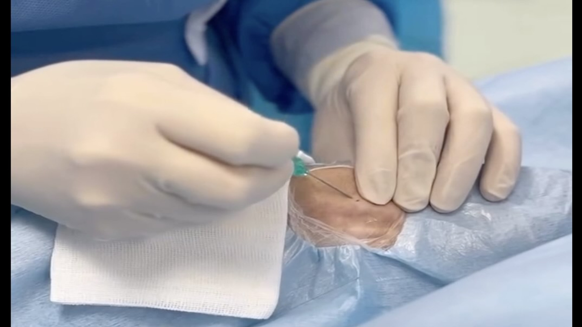 آنژیوگرافی عروق قلب پیلینگ شیمیایی