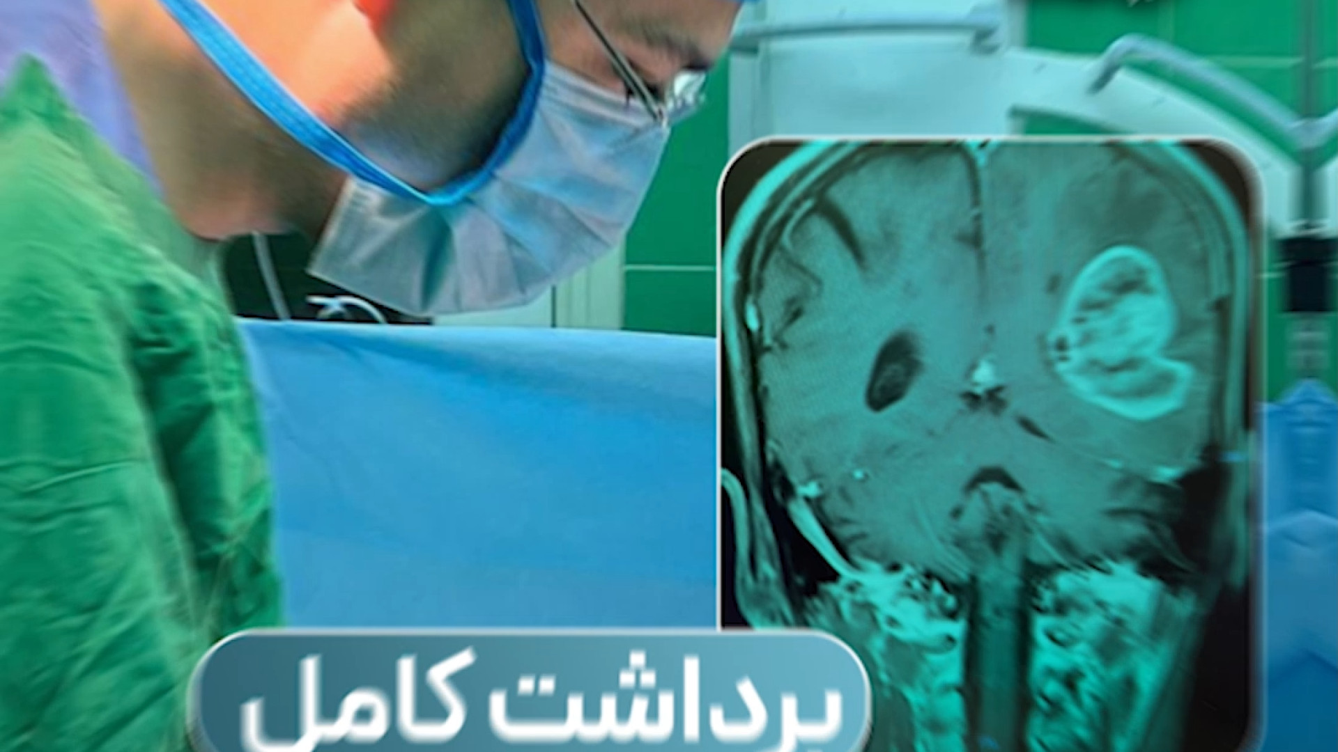 برداشت کامل تومور مغزی  | دکتر آرش فتاحی