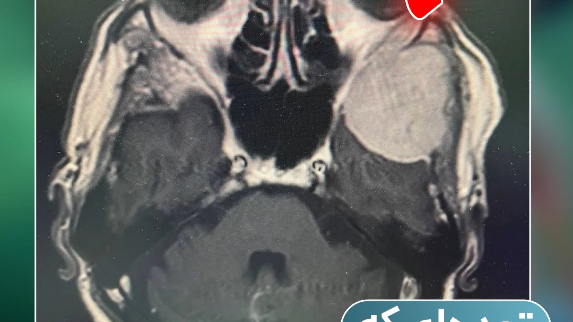 توموری که از پروستات به مغز رسیده!  | دکتر آرش فتاحی