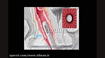 دستگاه التراسوندHIFU برای تنگ کردن واژن زیبایی پوست