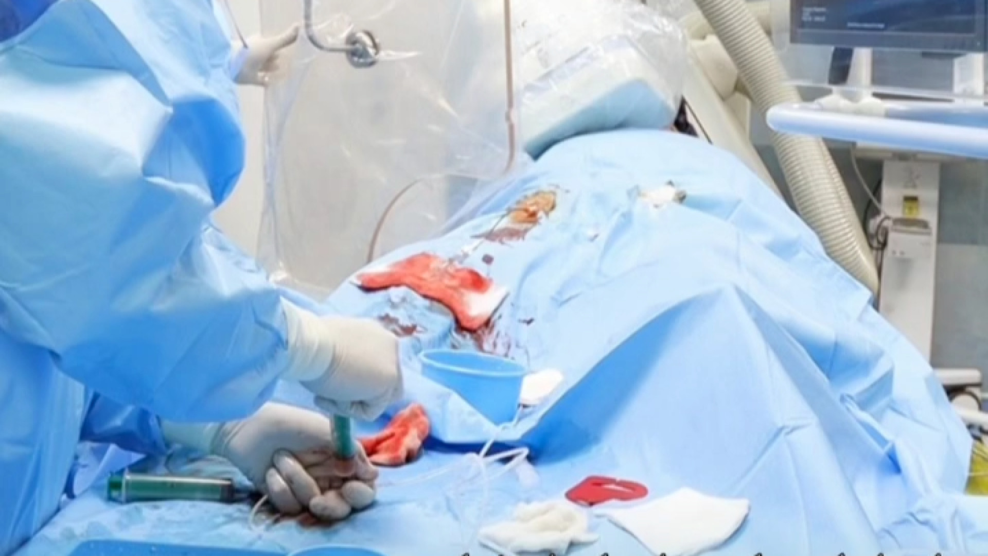 بهره‌برداری از دستگاه ریز مته الماس ۳۶۰ درجه در بخش آنژیوگرافی پر کردن دندان