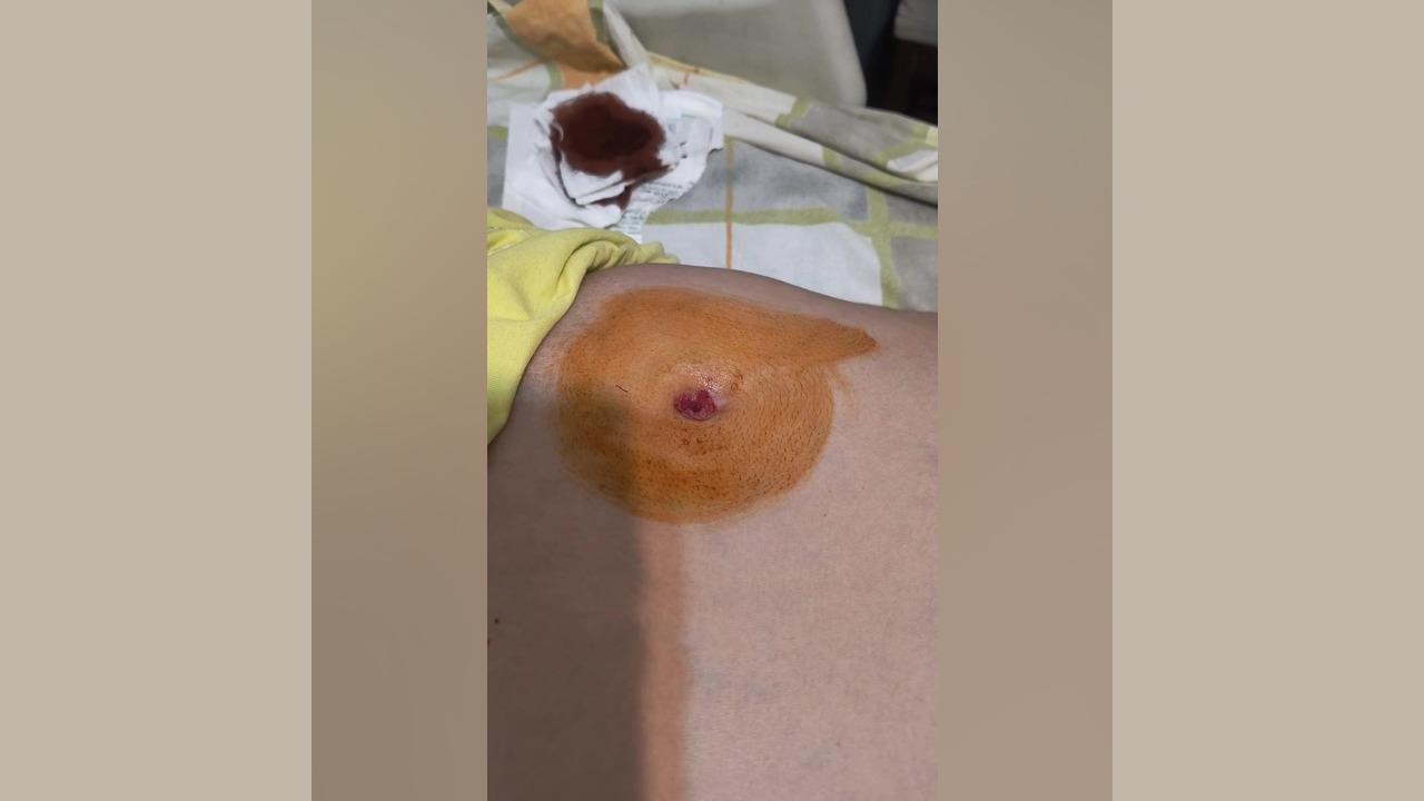 تعویض پگ معده در منزل | خدمات تخصصی آلام طب در تمام نقاط تهران لیفت صورت