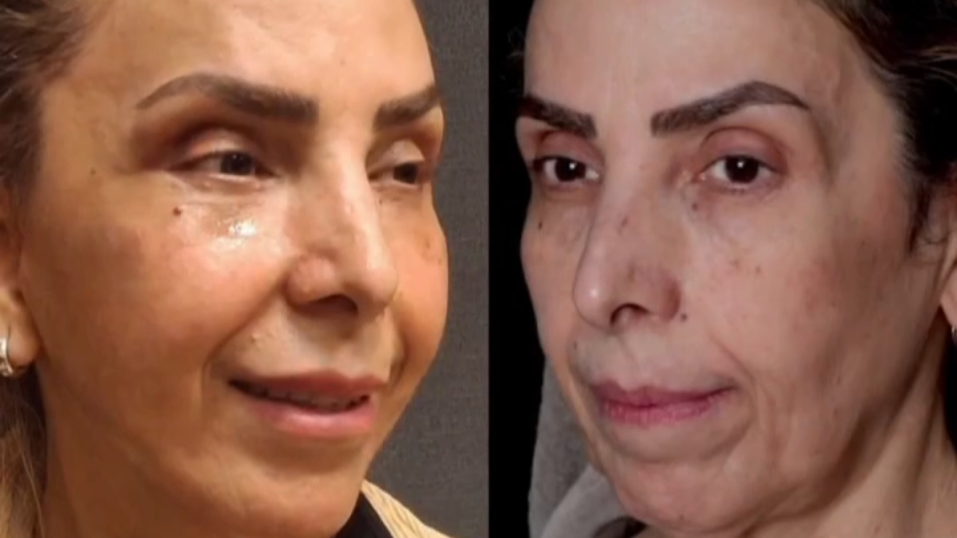 لیفت کامل صورت شامل پیشانی، شقیقه، گونه | دکتر پریا روانفر جاستین بیبر