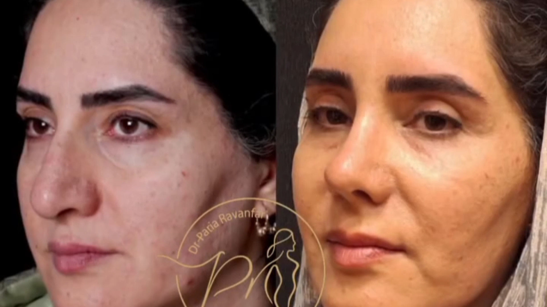 رینوپلاستی و بلفاروپلاستی پلک بالا | دکتر پریا روانفر لئوناردو دی‌کاپریو