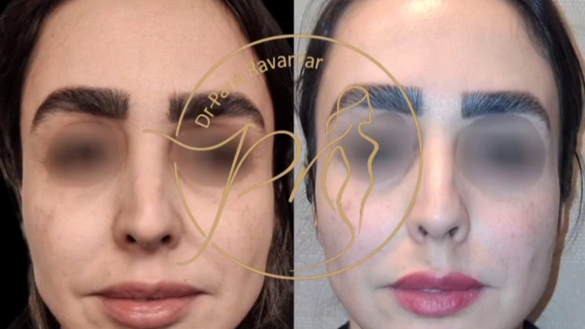 تزریق ژل چانه | دکتر پریا روانفر جراحی زیبایی پلک