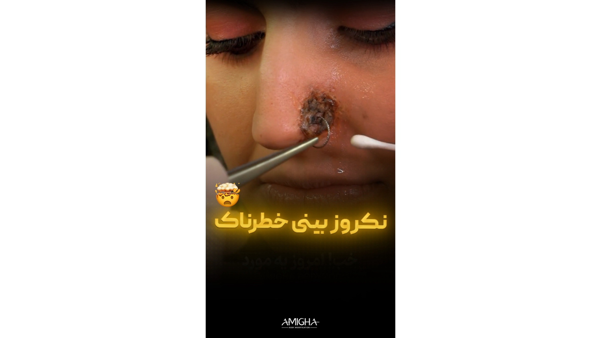 نکروز بینی خطرناک پله