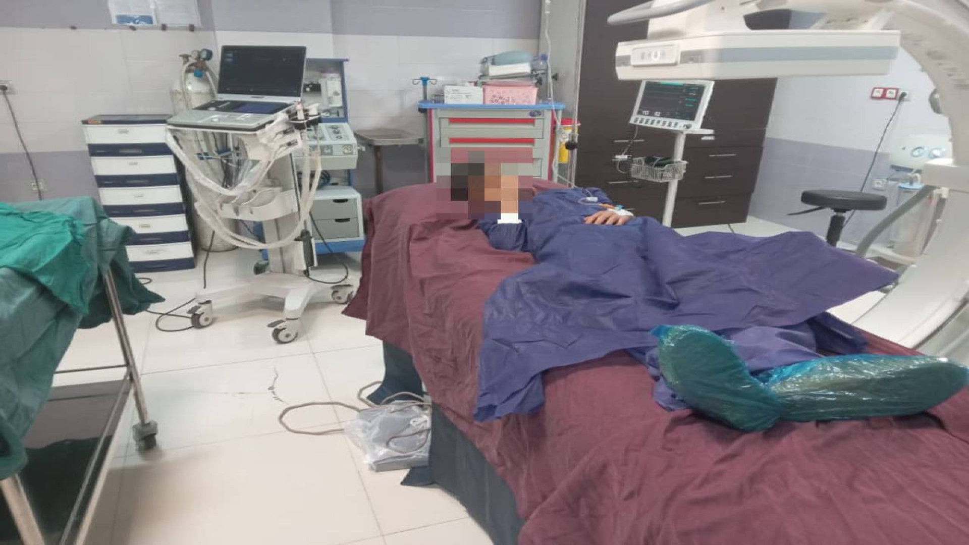 گزارش درمان _ آنژیوگرافی رضا برداشتن خال