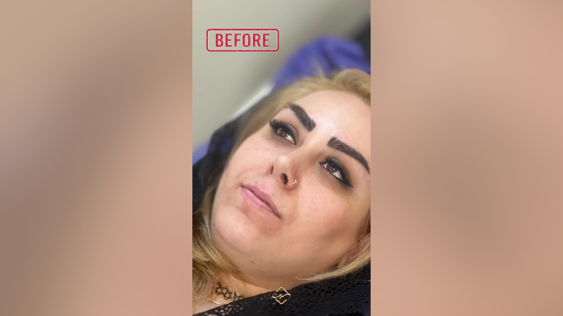 قبل و بعد از ساکشن غبغب آتپازیب