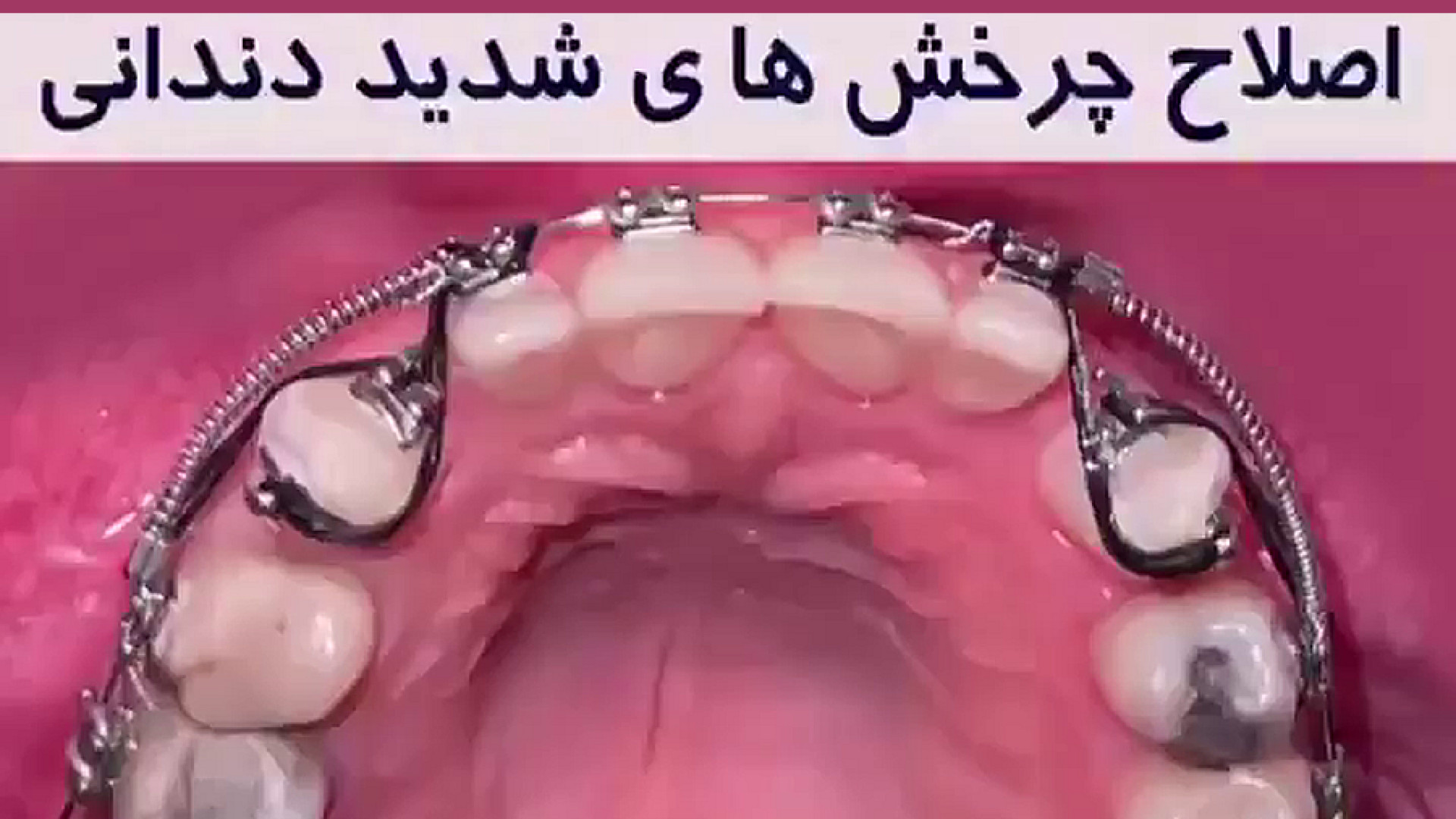 درمان ارتودنسی بی نظمی و چرخش شدید دندان های نیش اکتروپیون