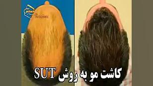 پیوند مو به روش SUT مرکز مو رنسانس اینسایزینگ