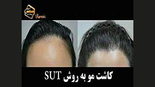 پیوند مو به روش SUT مرکز مو رنسانس جرمگیری