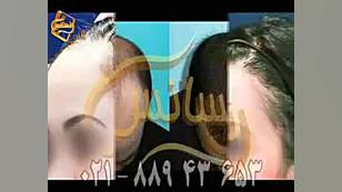 پیوند مو به روش SUT مرکز مو رنسانس دکتر پوست