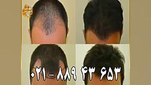 پیوند مو به روش SUT مرکز مو رنسانس پیلینگ