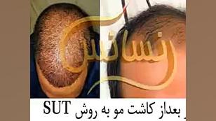 پیوند مو به روش SUT مرکز مو رنسانس اتوپلاستی