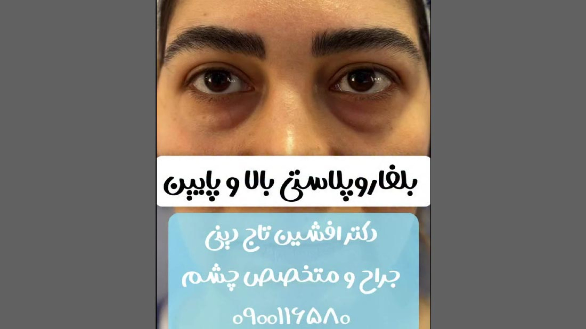 نمونه درمان بلفاروپلاستی