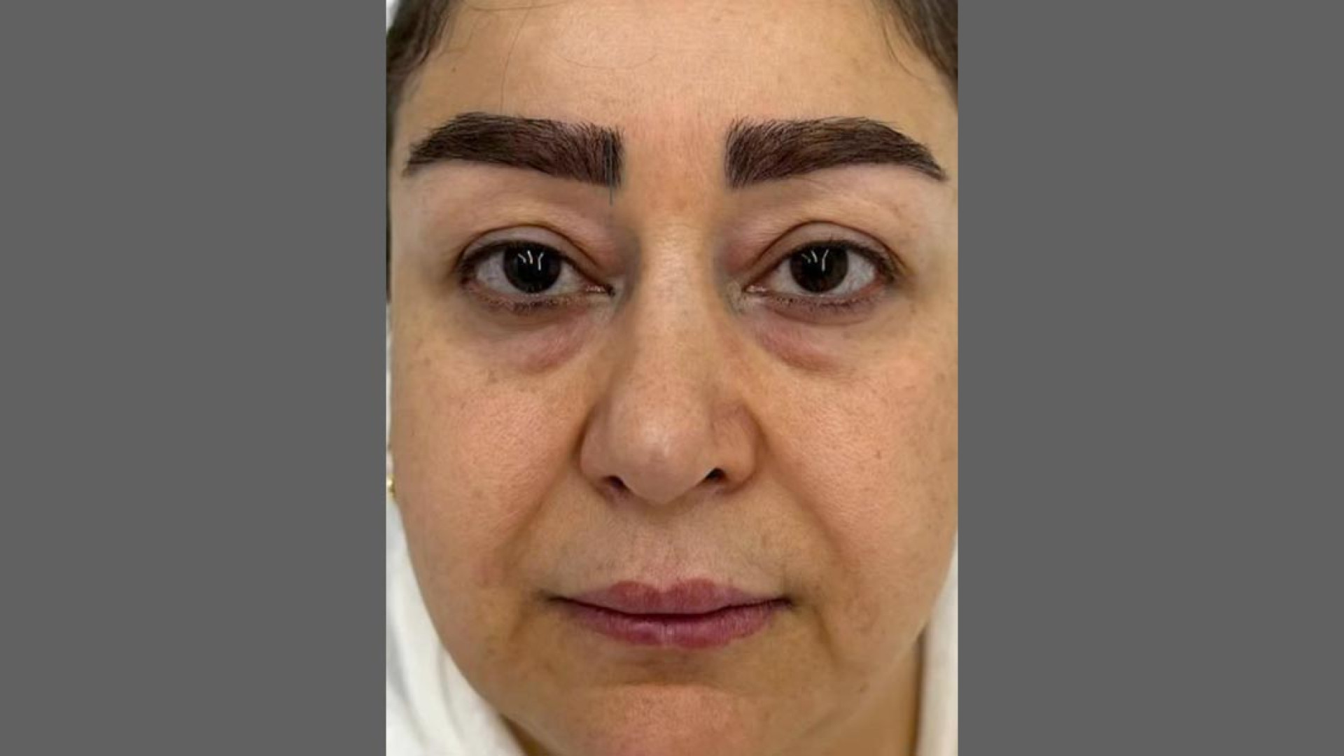 نمونه درمان بلفاروپلاستی