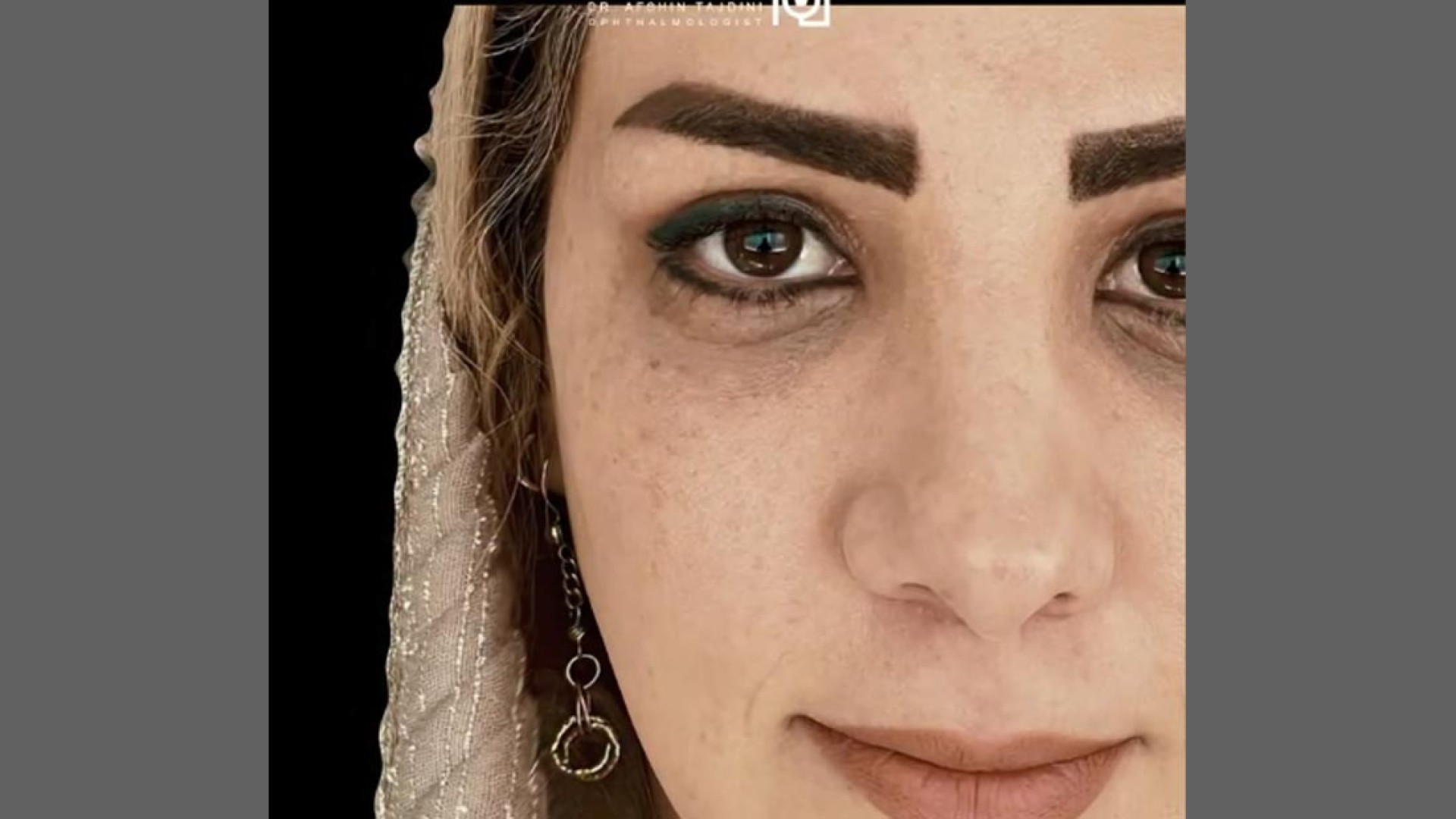 نمونه درمان بلفاروپلاستی