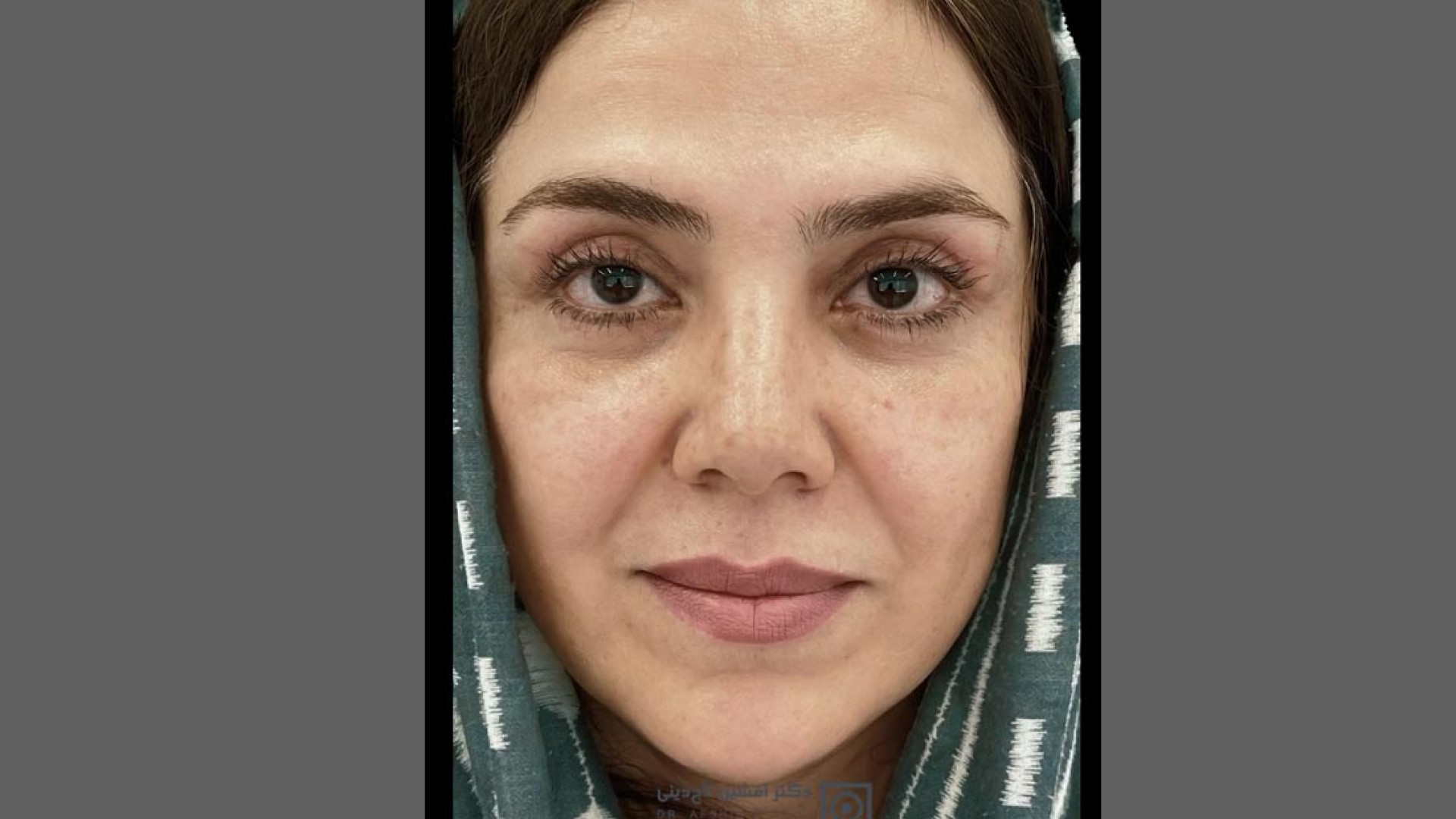 نمونه درمان بلفاروپلاستی