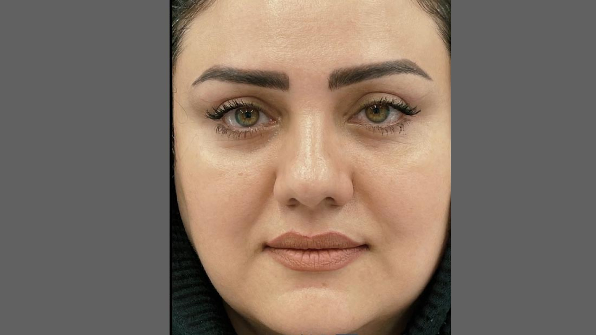 نمونه درمان بلفاروپلاستی