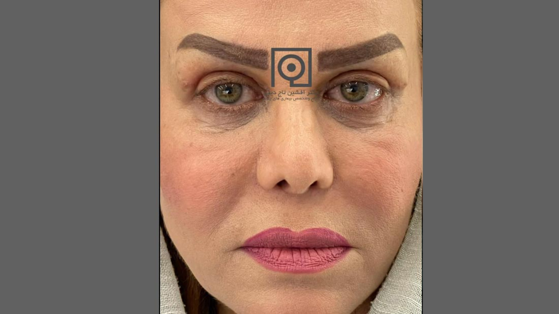 نمونه درمان بلفاروپلاستی