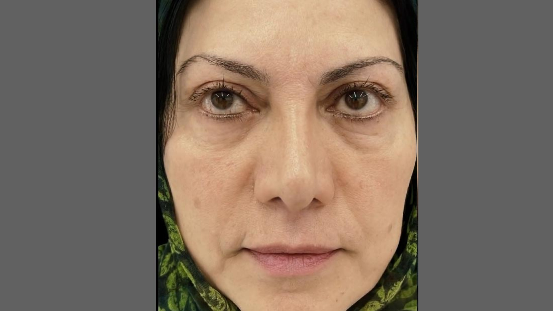 نمونه درمان بلفاروپلاستی