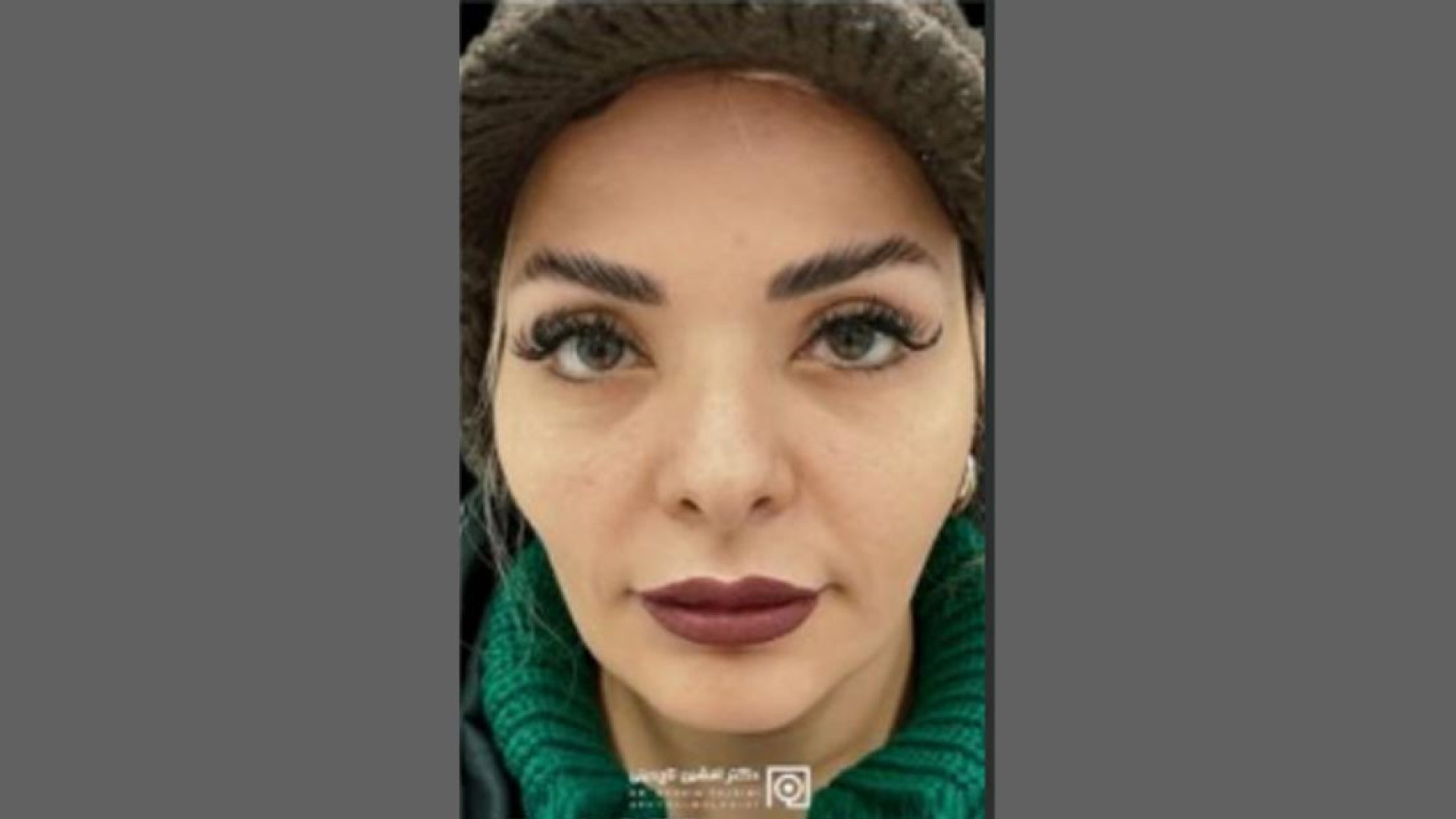 نمونه درمان بلفاروپلاستی