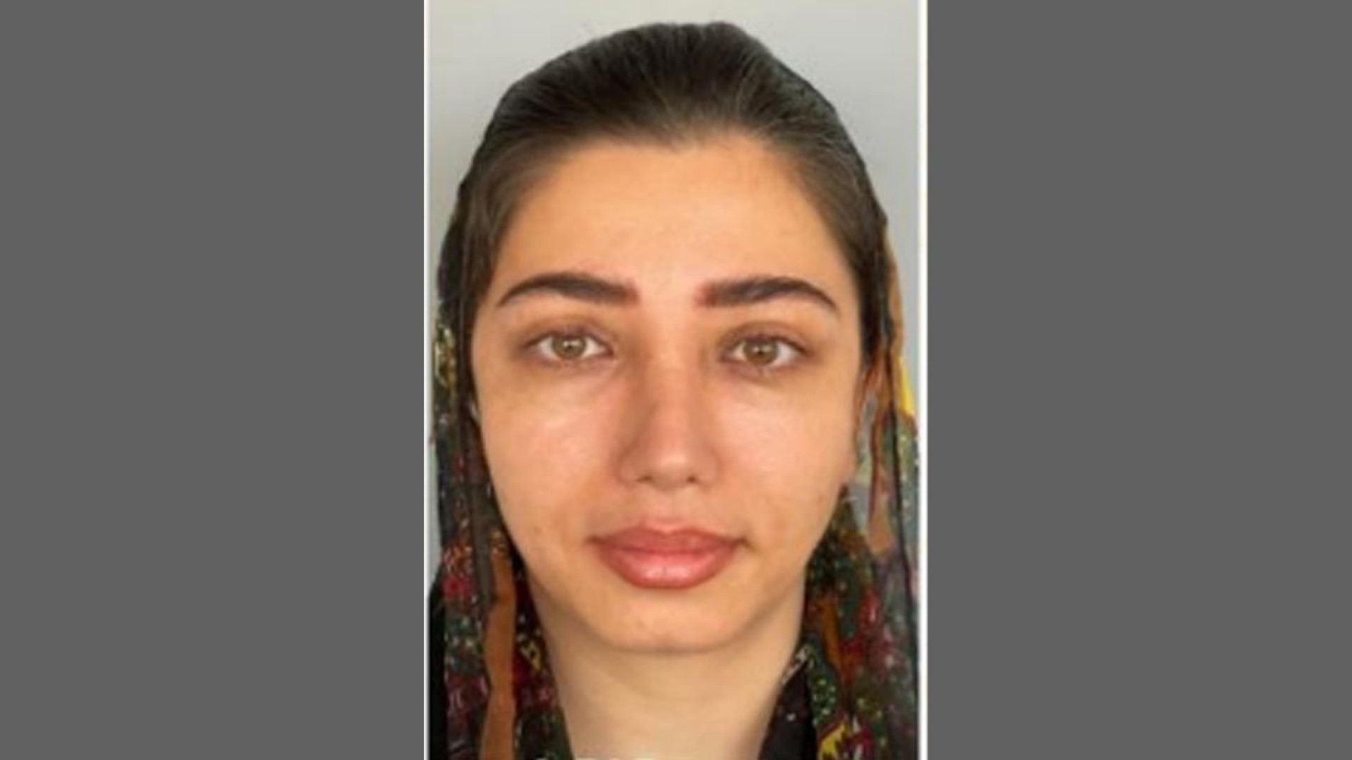 نمونه درمان بلفاروپلاستی