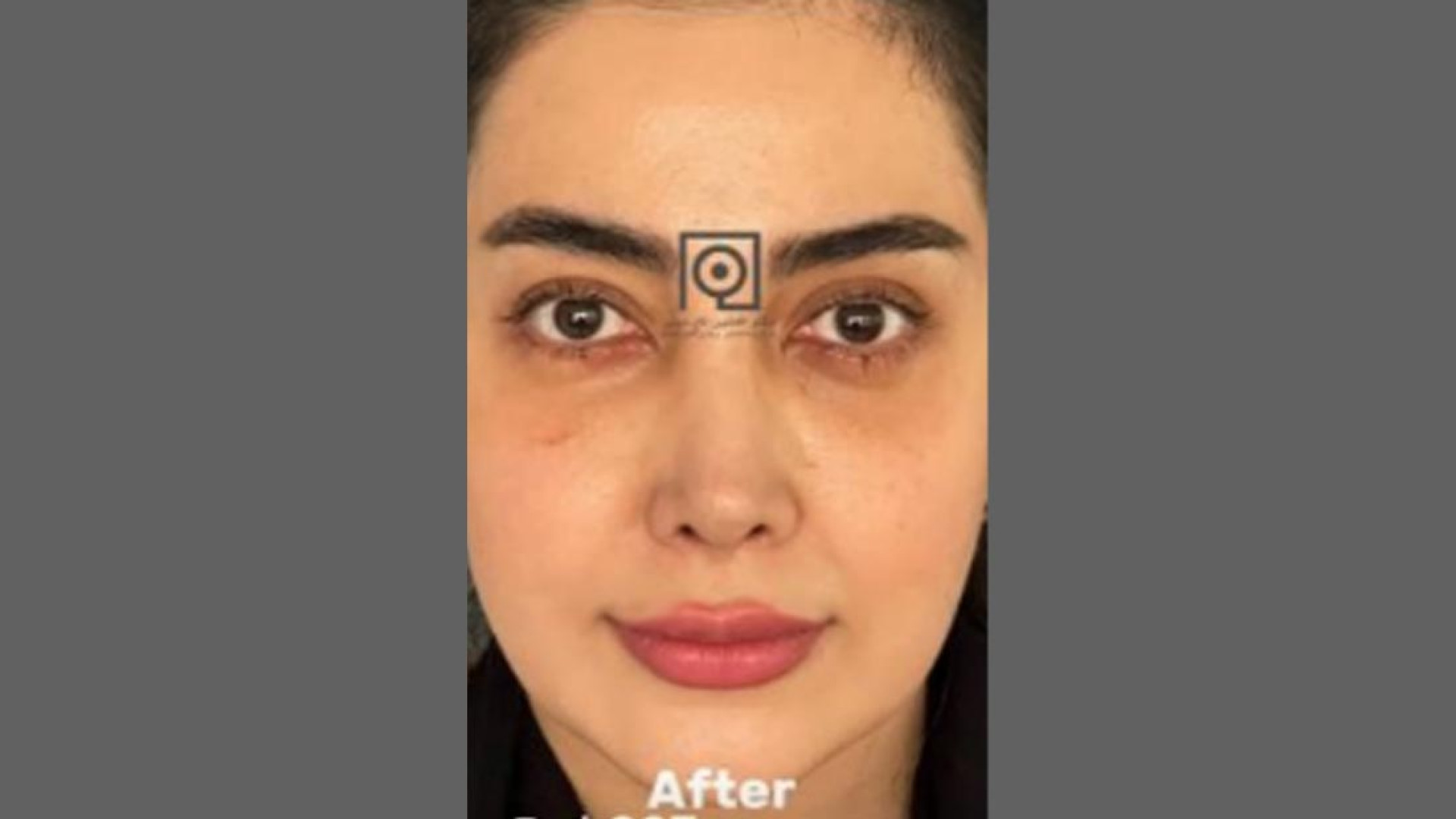 نمونه درمان بلفاروپلاستی