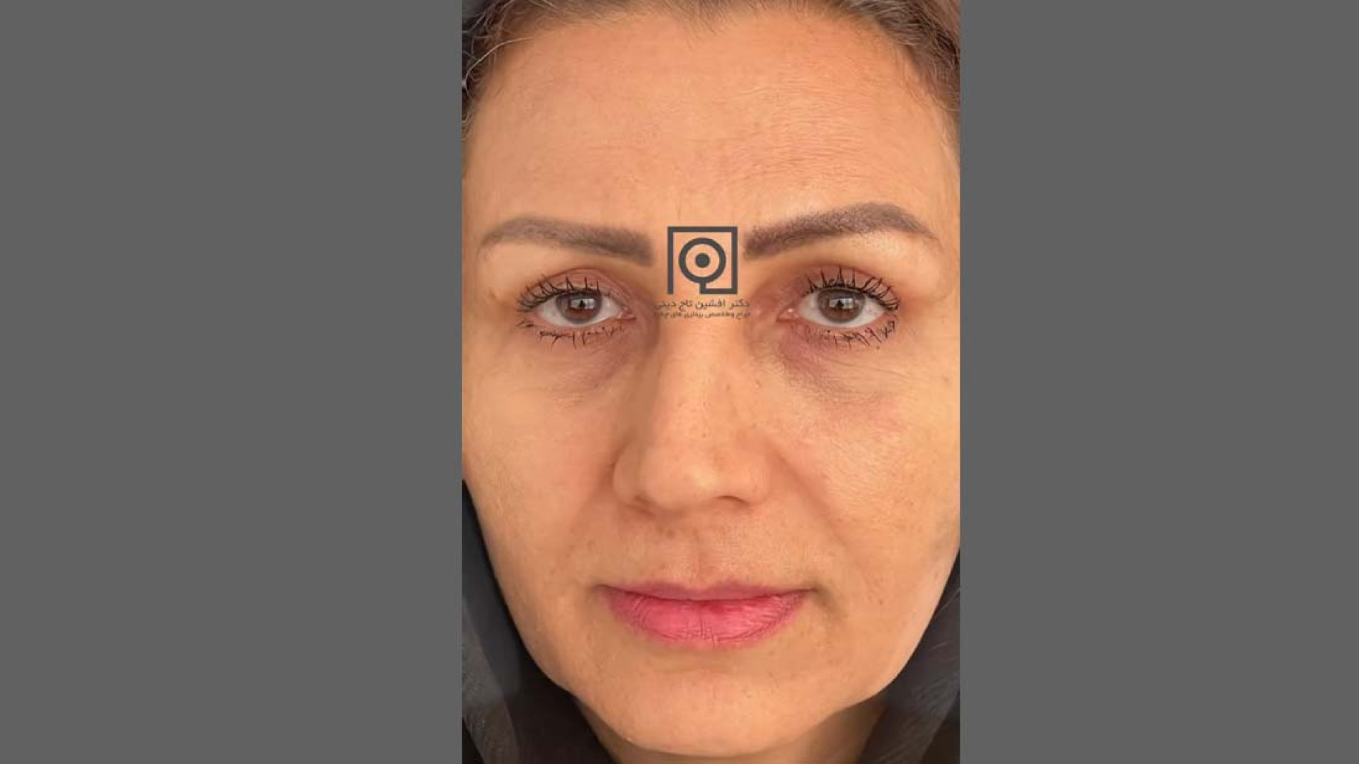 نمونه درمان بلفاروپلاستی