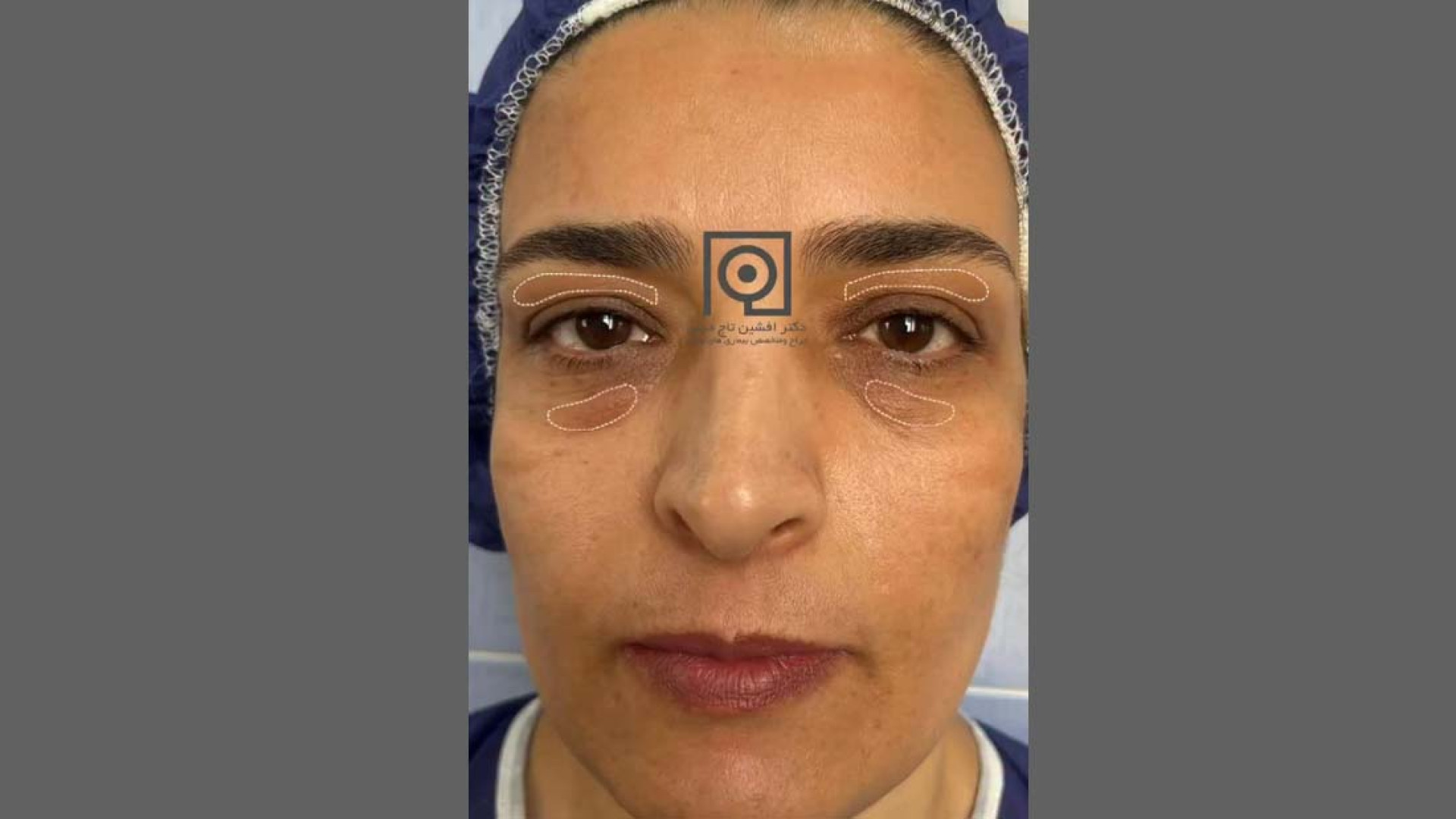 نمونه درمان بلفاروپلاستی