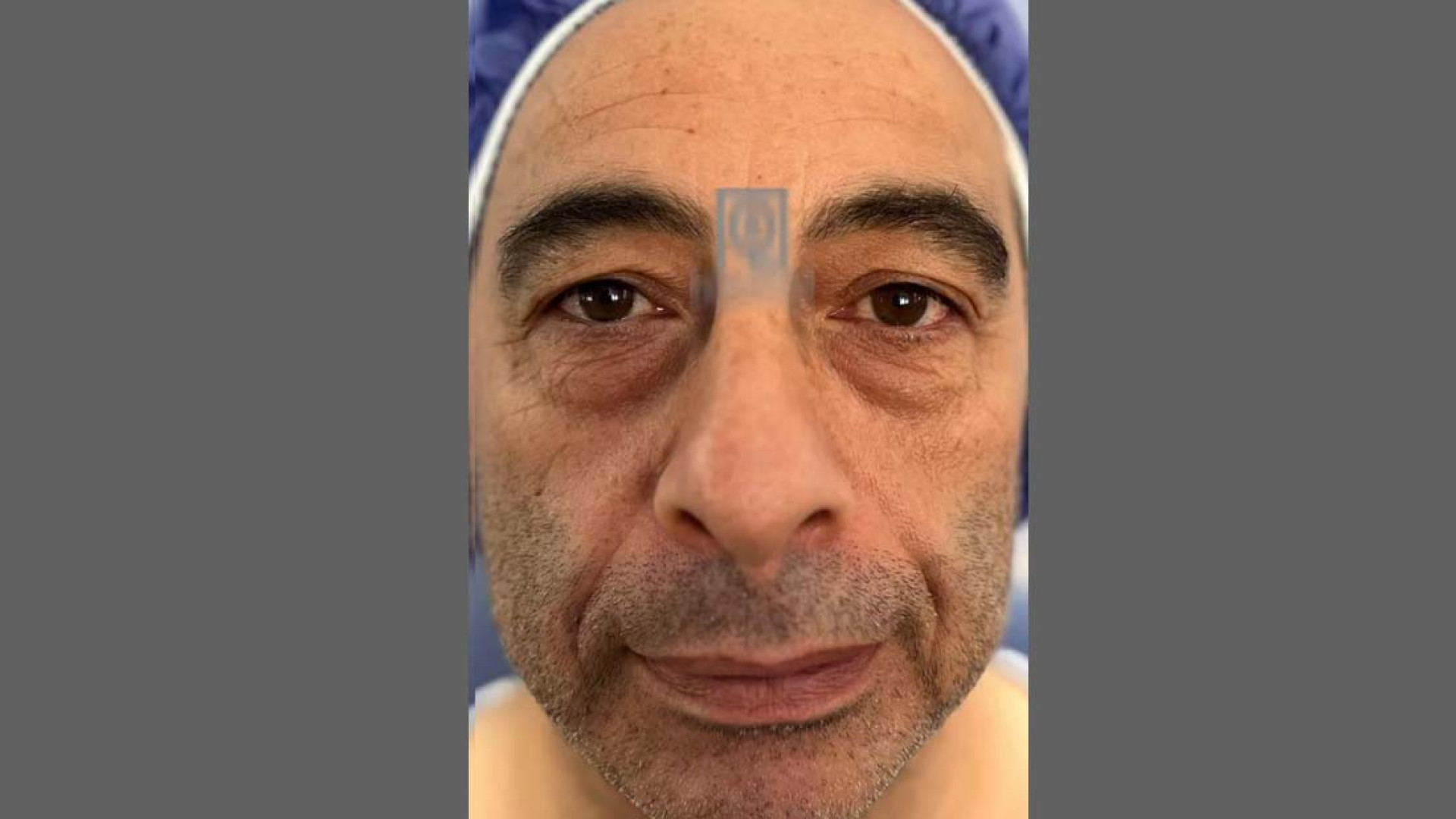 نمونه درمان بلفاروپلاستی