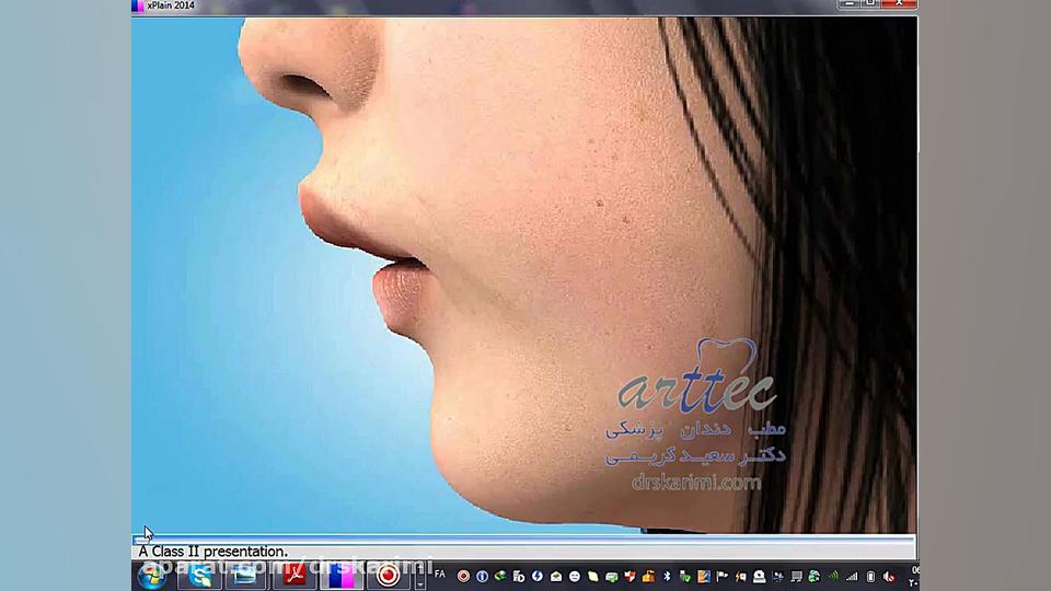 جراحی فک میکرونیدلینگ