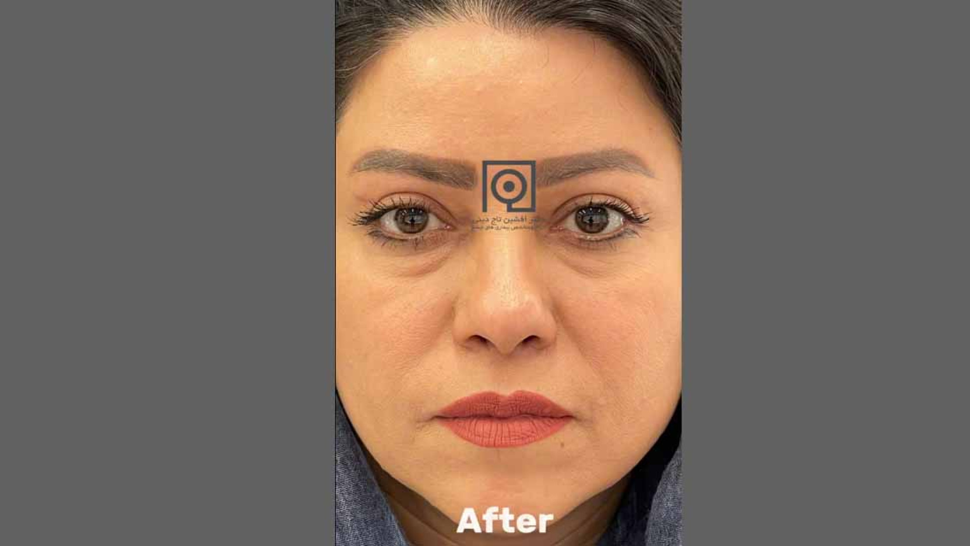 نمونه درمان بلفاروپلاستی