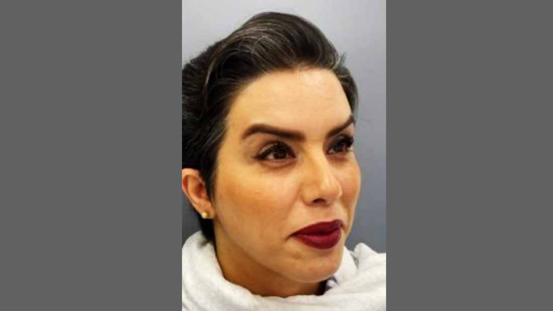 نمونه درمان بلفاروپلاستی