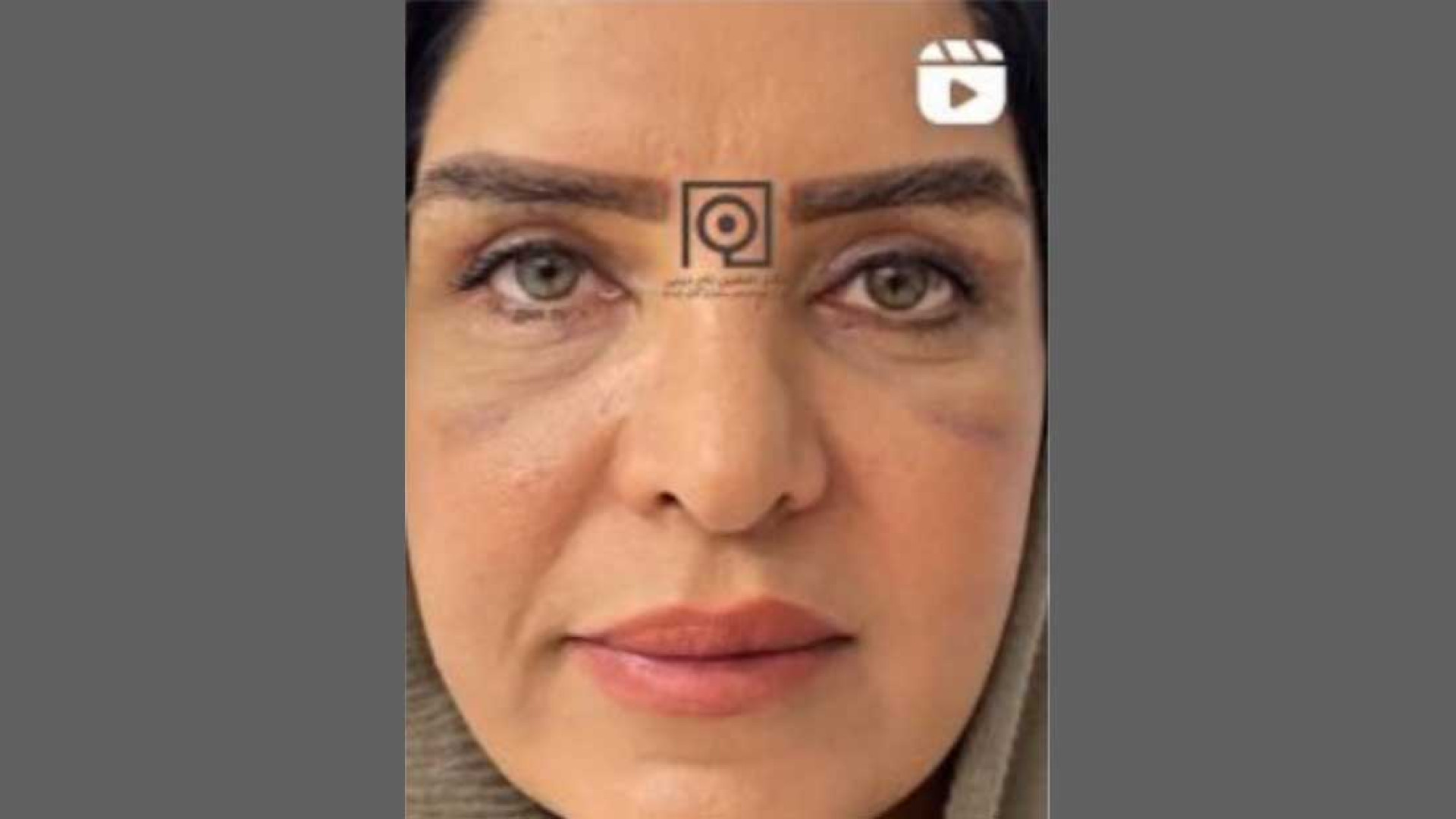 نمونه درمان بلفاروپلاستی