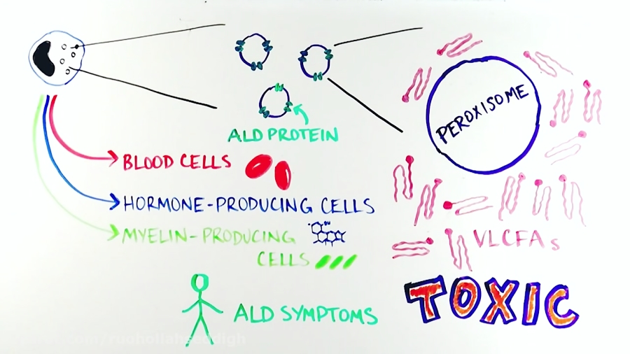 adrenoleukodystrophy-disease-causes-symptoms-diagnosis-prognosis