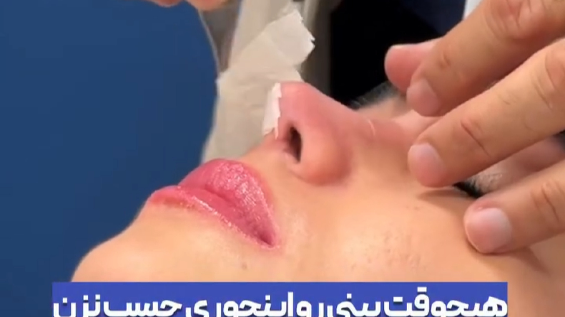 نکات مهم چسب بینی | دکتر جواد یزدانی