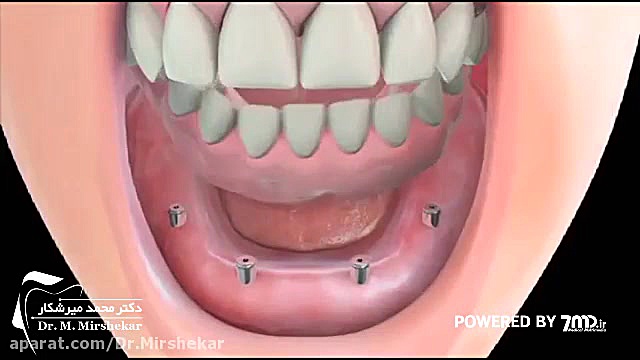 پروتز اوردنچر هیدروراکس
