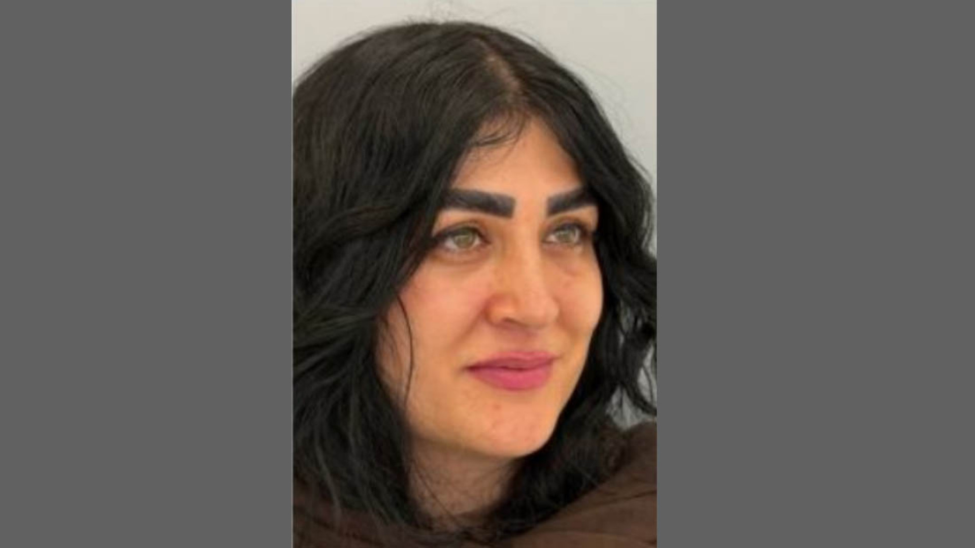 نمونه درمان بلفاروپلاستی