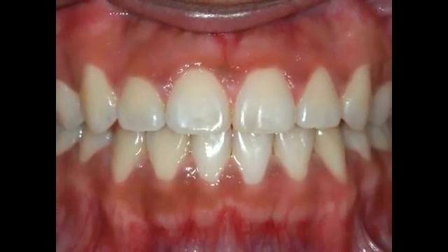 طریقه صحیح مسواک زدن با دندانهای ارتودنسی شده دستگاه فلوئورسنس تایم-لپس
