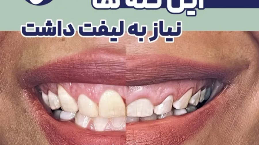 لیفت لثه | دکتر ستاره هاشمی