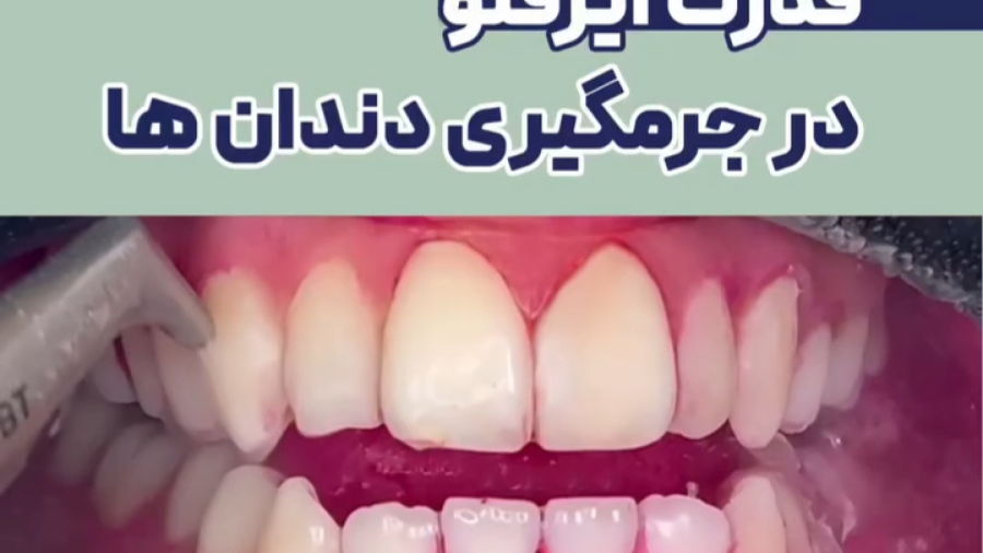 قدرت ایرفلو در جرمگیری دندانها| دکتر ستاره هاشمی