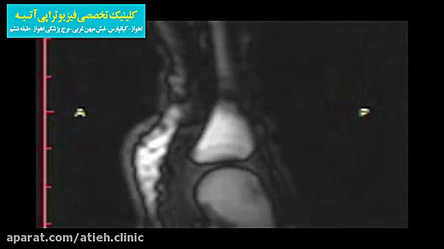 تصویر MRI حین شکستن قولنج انگشت دست جراحی پف زیر چشم