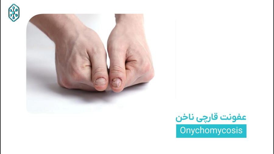 خرید لاک دارویی از فروشگاه انتی کالا