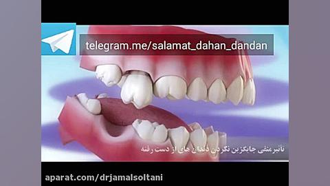 تاثیر منفى جایگزین نكردن دندان از دست رفته دکتر جمال سلطانی دندانپزشک خوب در تبریز