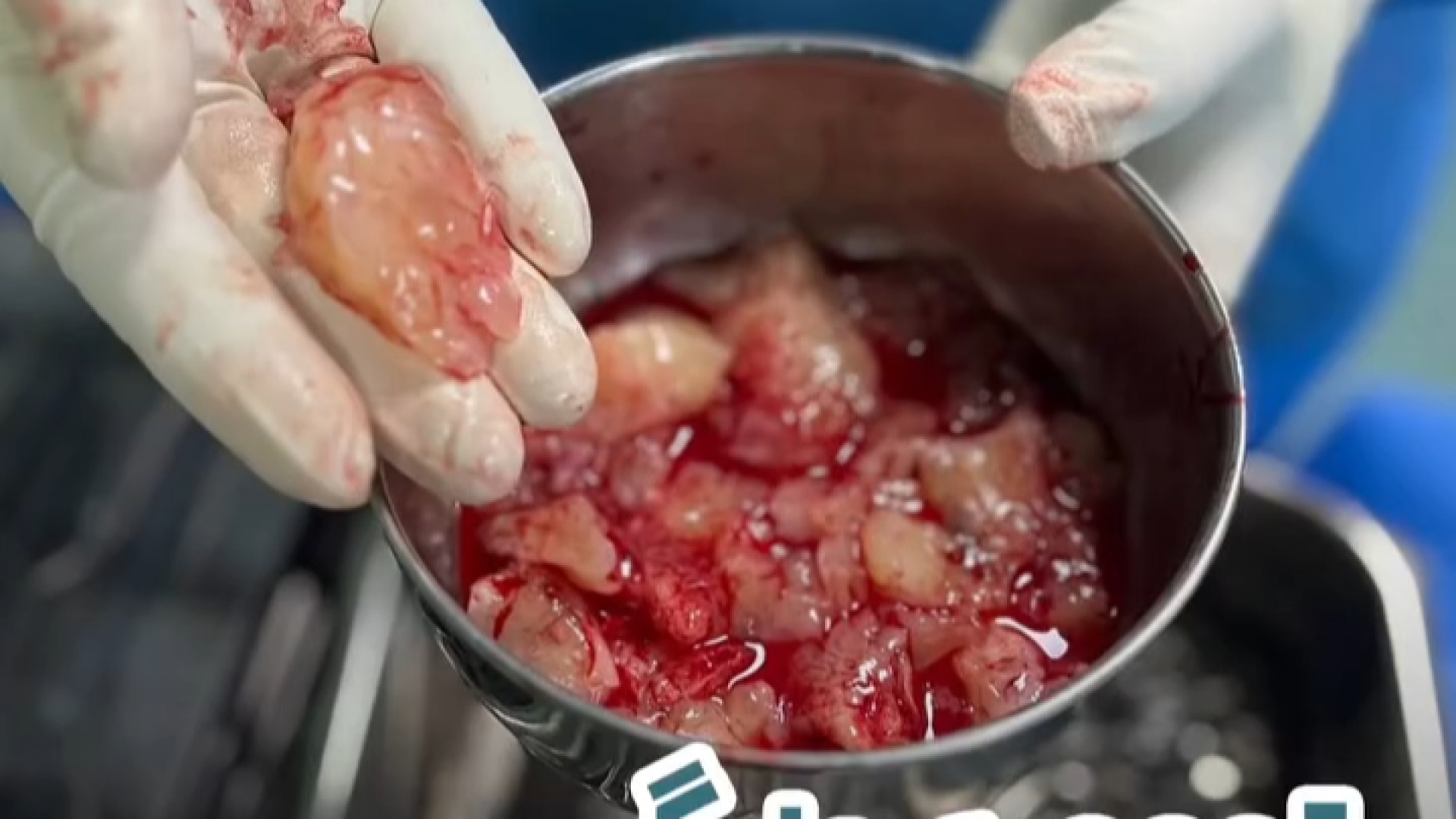 توموری بزرگ در سر جوان 25 ساله | دکتر آرش فتاحی